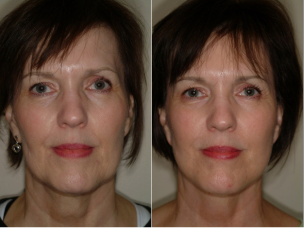 facelift before after